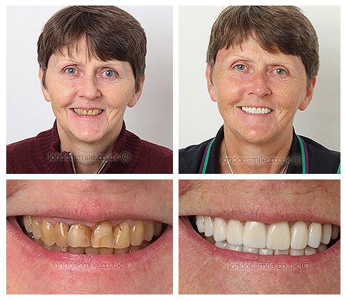 Patient Claire smile story