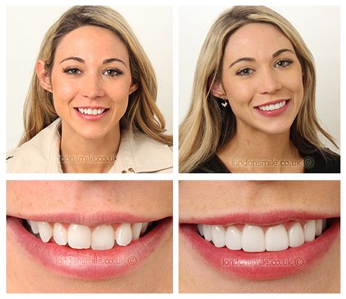 Patient nervous phobia smile transformation