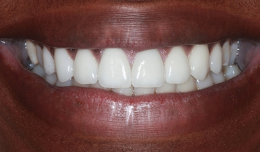 Asymmetrical gingival margins before contouring