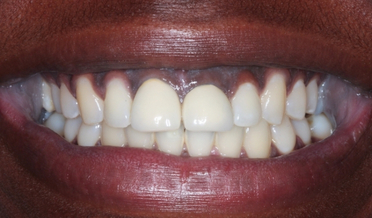 Balanced gingival line framing teeth after treatment