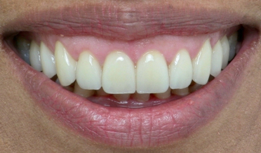 Excessive gingival display before laser lift