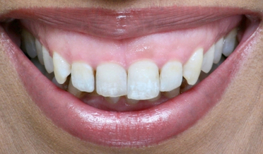 Harmonious tooth-to-gum proportion after laser lift