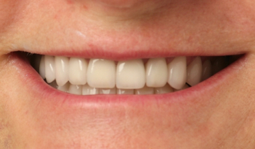 Patient 19: Asymmetrical incisal plane before veneers