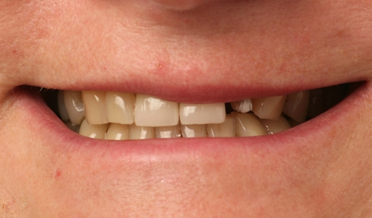Patient 19: Perfect lip harmony and incisal line after veneers