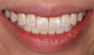 Yellowed tea and coffee stained teeth before whitening
