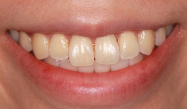 Radiant B1 shade after Philips Zoom and Enlighten power whitening