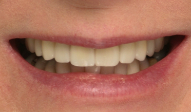 Patient 20: Narrow arch and inward-slanting smile before veneers