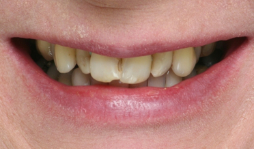 Patient 20: Broad, balanced aesthetic smile corridor after veneers