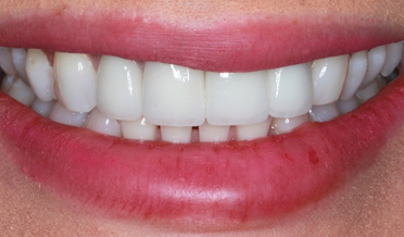 Patient 21: Fractured front teeth and aged composite restorations before veneers