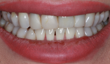 Patient 21: Smooth, youthful smile arc restored with porcelain veneers