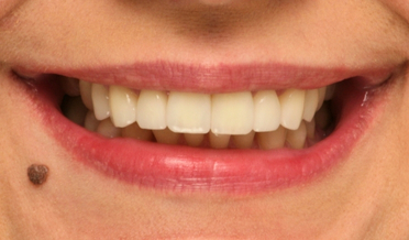 Dark intrinsic discolouration before veneers
