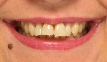 Luminous natural vitality restored with veneers