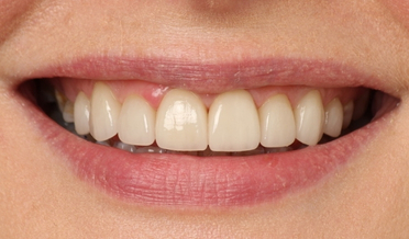 Anterior spacing and chipping before treatment