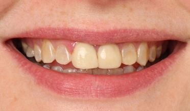 Restored symmetry and closed diastemas after treatment