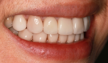 Porcelain veneers before treatment: uneven edges and wear
