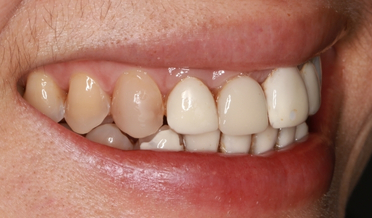 Porcelain veneers after treatment: natural translucency and harmonious smile