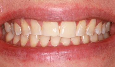 Aged dark teeth before whitening