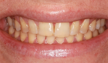Bright, healthy enamel sheen after in-clinic power whitening