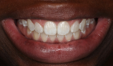 Uneven tooth lengths and jagged edges before treatment