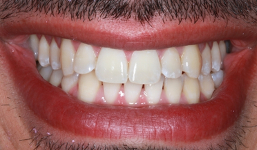 Uneven blotchy enamel before whitening