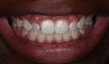 Harmonious incisal edge line after bonding