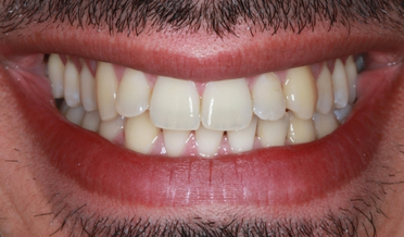 Even, radiant smile after prescribed custom trays