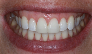 Fractured tooth corner before repair