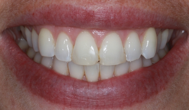 Seamless composite edge repair