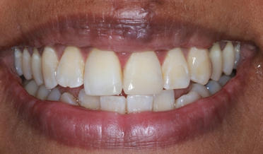 Gap between front teeth before composite closure