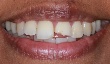 Flawless gap closure with composite bonding