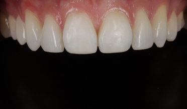 Chipped and uneven front teeth before bonding