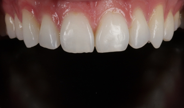 Same-day sculpted composite bonding after treatment