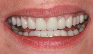 Irregular gum scalloping before treatment