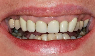 Harmonious gingival arches after treatment