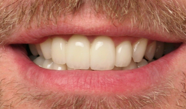 Short clinical crowns covered by excess tissue