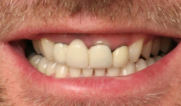 Elongated, elegant tooth proportions restored