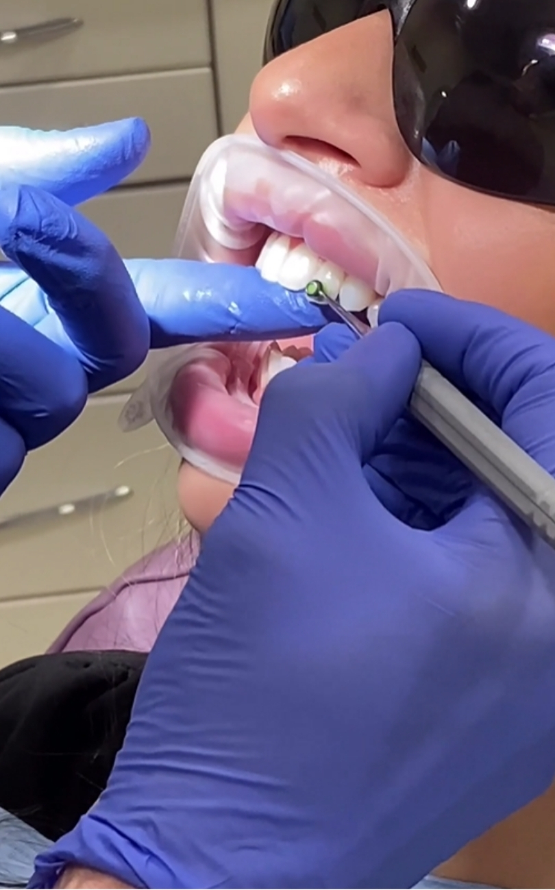 Composite bonding procedure in London